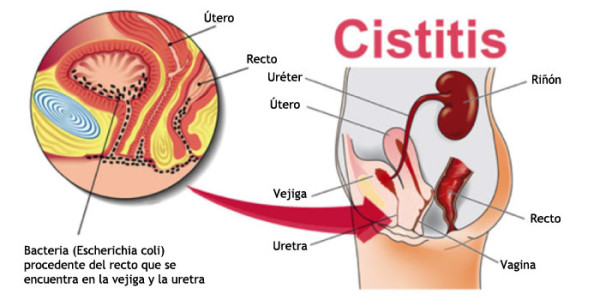 cistitis