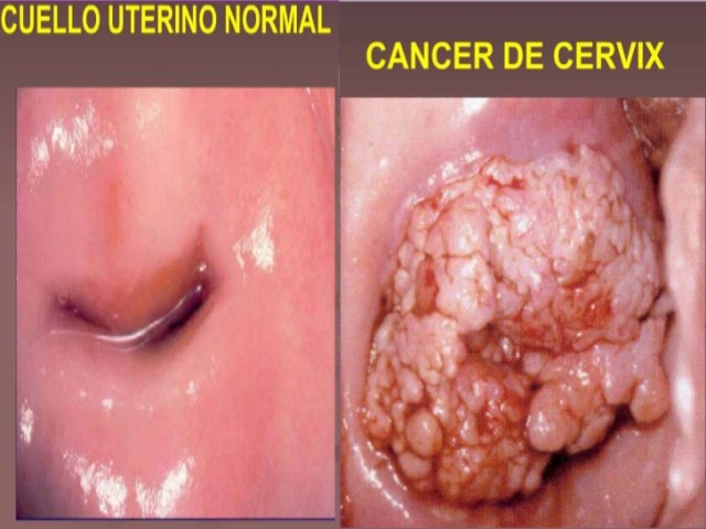 cancer-invasivo-de-cuello-uterino-15-728