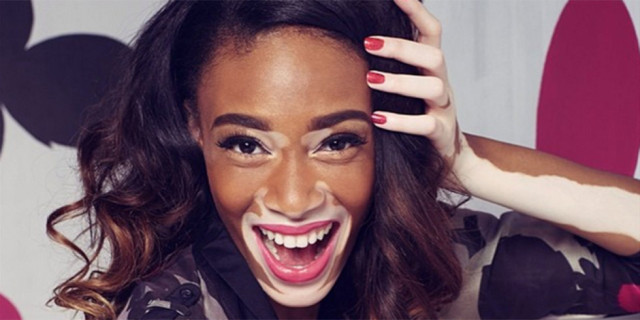 nrm_1408008896-winnie-harlow-antm-vitiligo