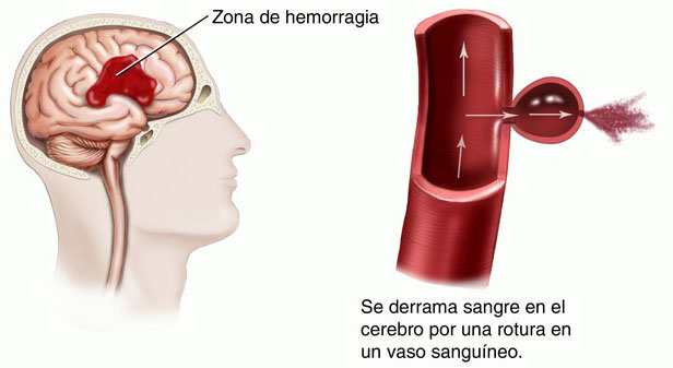 stroke-hemorragico