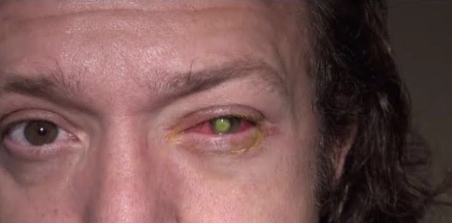 Este hombre pierde su vista por causa de los lentes de contactos