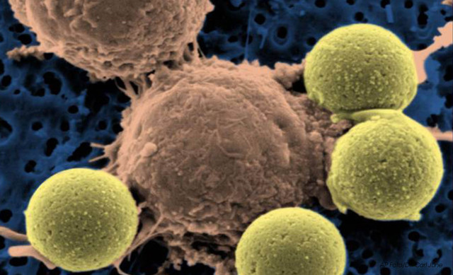 Esta imagen microscópica proporcionada por el doctor Carl June el miércoles 10 de agosto del 2011 muestra células T del sistema inmunológico (centro). Una vez modificadas, estas células están ayudando a combatir la leucemia en una nueva investigación   (AP Foto/Dr. Carl June)