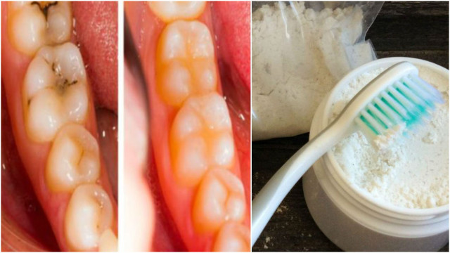 caries