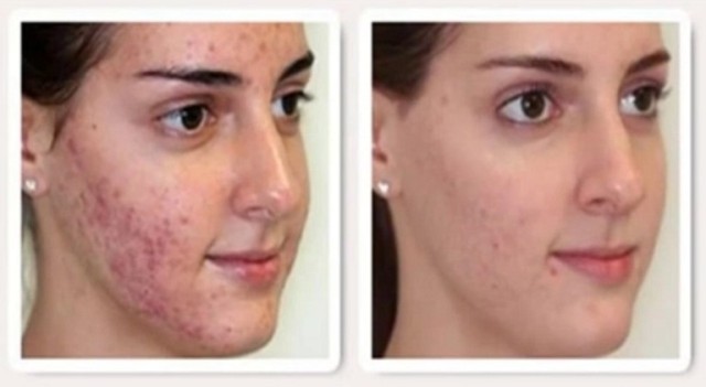 tratamiento natural acne