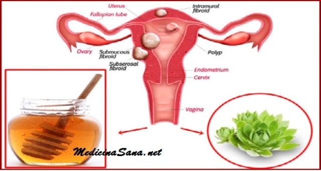 La-mezcla-de-estos-2-Ingredientes-Muertes-quistes-y-fibromas