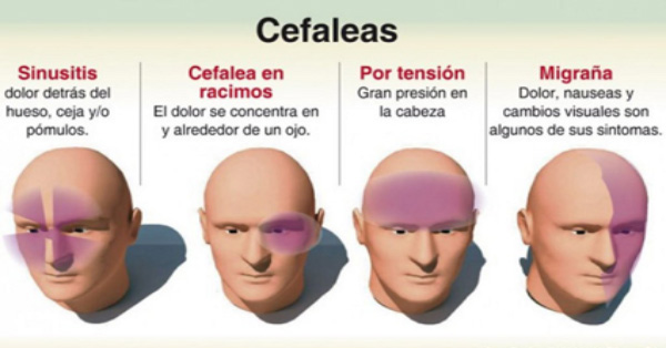 dolor cabezaa cefalea