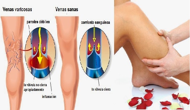 prevenir-las-varices