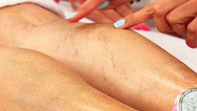 varices-como-eliminar