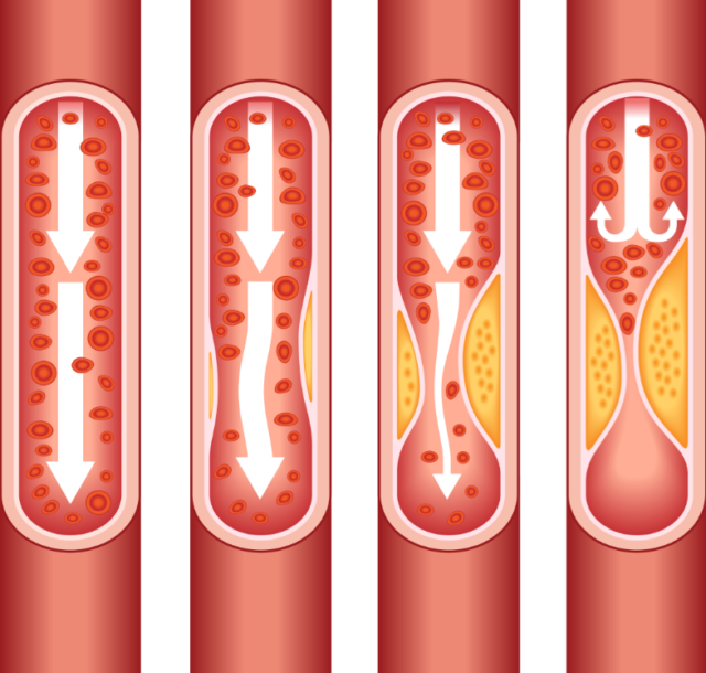 arterias