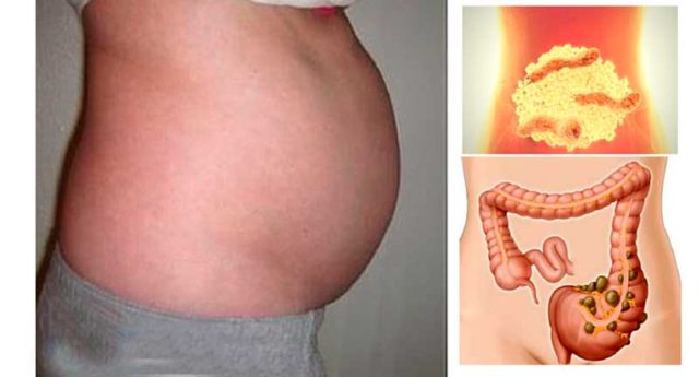 barriga-hinchada