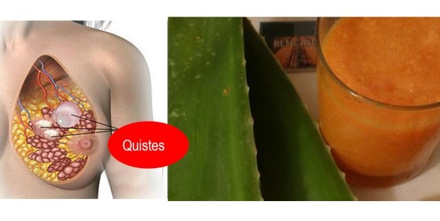 elimina-los-quistes
