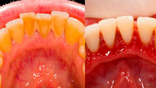placa-y-sarro-dientes-e1473551218544