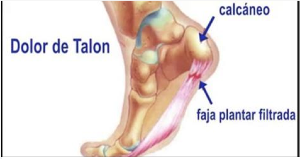 dolor-talon