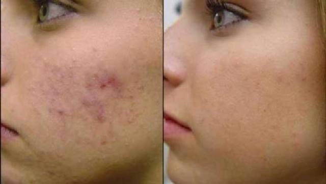 acne1